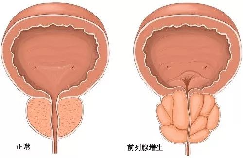 前列腺增生，尿頻、尿急怎么辦？等離子電切術(shù)治愈！